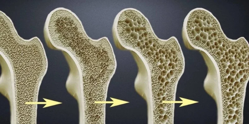 Osteoporosis